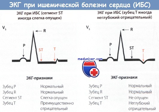 ЭКГ под нагрузкой — назначение, процедypa и противопоказания 