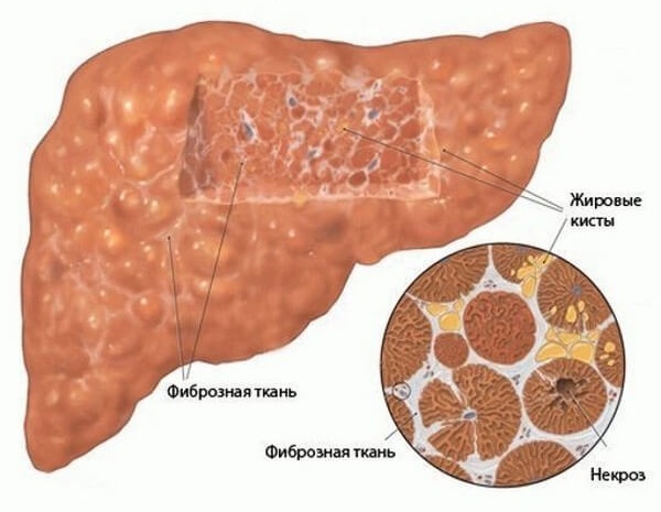 Фиброз печени 